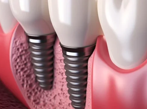Dental bone grafting assessment at City Dental Clinic in Tirana