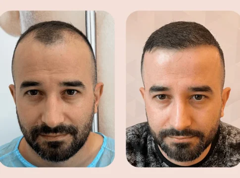 DaVINCI Clinic hair-transplant service in Tirana