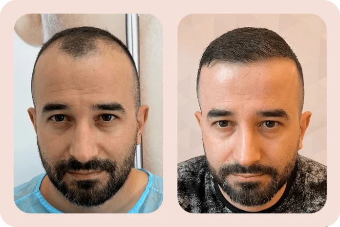 DaVINCI Clinic hair-transplant service in Tirana