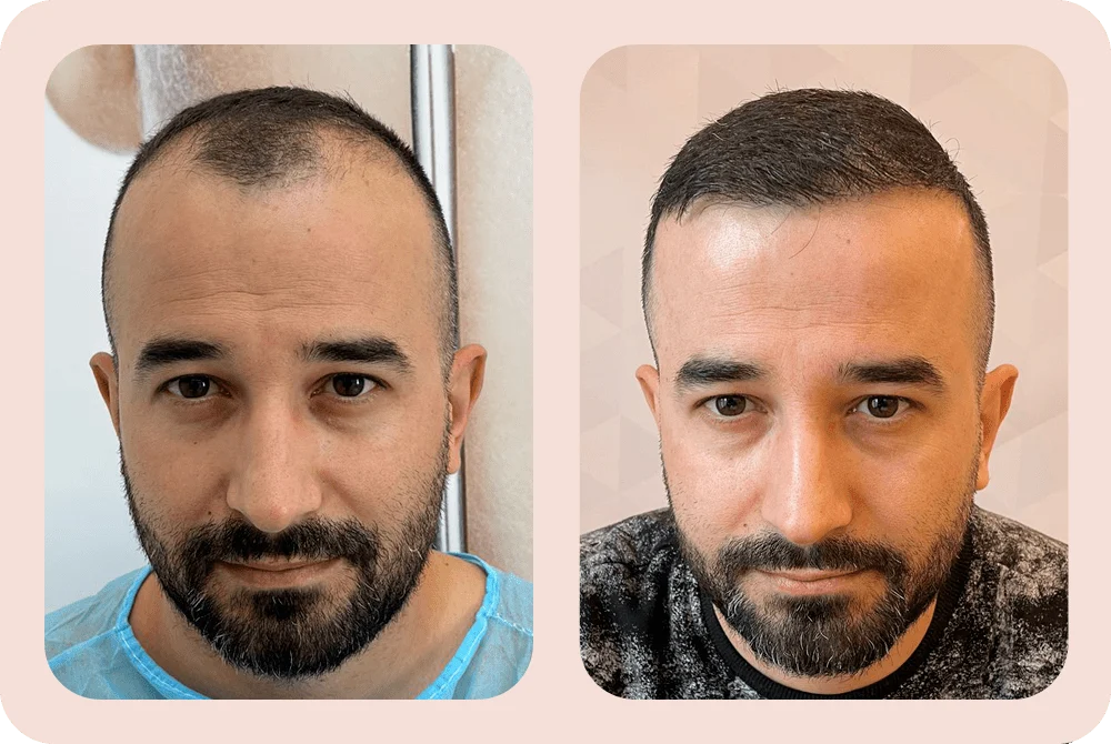 DaVINCI Clinic hair-transplant service in Tirana
