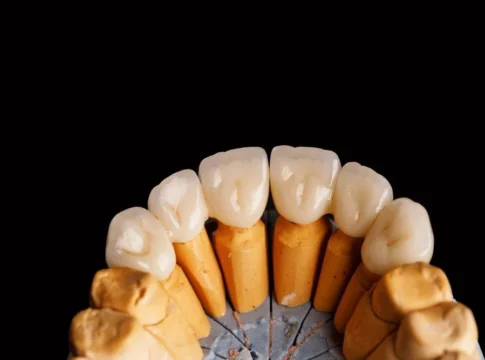 Dental crown treatment planning at City Dental Clinic in Tirana