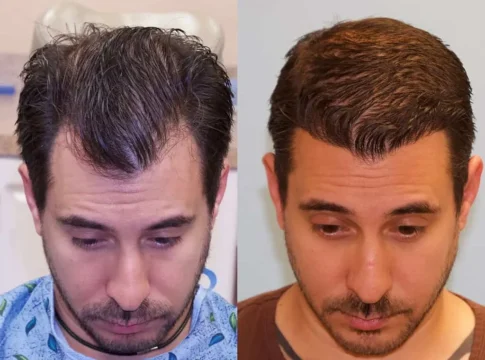 Hygeia Hospital Tirana hair-transplant service