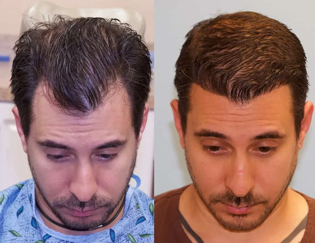 Hygeia Hospital Tirana hair-transplant service