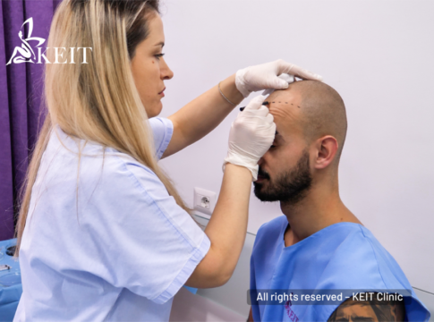 KEIT Clinic hair-transplant service in Tirana
