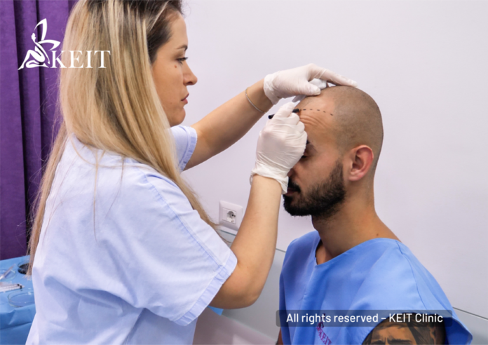 KEIT Clinic hair-transplant service in Tirana