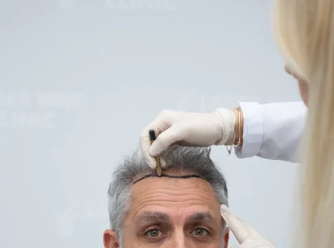 Laser Way Clinic hair-transplant service in Tirana