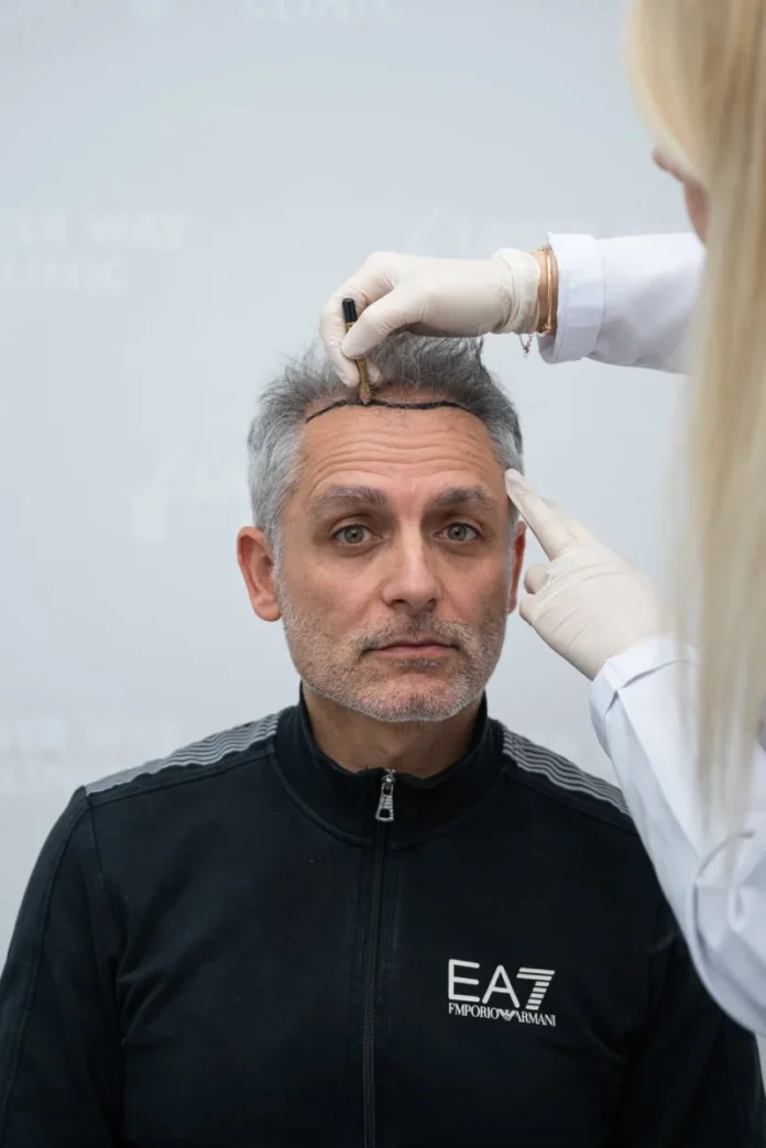 Laser Way Clinic hair-transplant service in Tirana