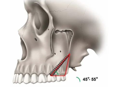 Clinical illustration of pterygoid implant placement from City Dental Clinic