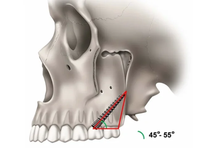 Clinical illustration of pterygoid implant placement from City Dental Clinic